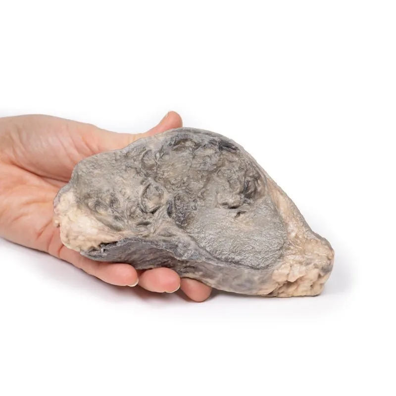 3D Printed Carcinoma of Breast
