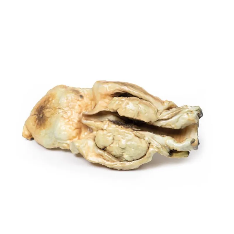 3D Printed Carcinoma of Larynx  with a 2 Months History of Dysphagia