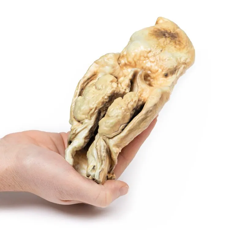 3D Printed Carcinoma of Larynx  with a 2 Months History of Dysphagia