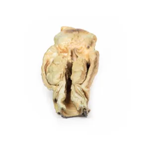 3D Printed Carcinoma of Larynx  with a 2 Months History of Dysphagia