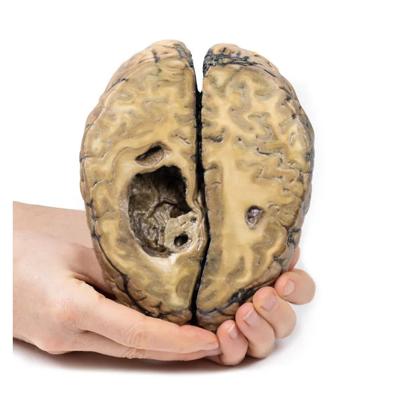 3D Printed Metastatic Carcinoma in the Brain